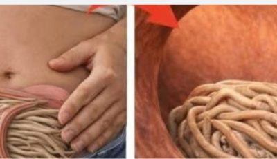 Garlic eliminates parasites in just 1 day? What you really should know before trying it